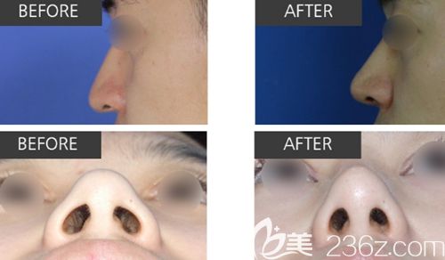 韓國(guó)清潭優(yōu)整形外科softxil鼻整形案例 韓國(guó)清潭優(yōu)整形外科softxil鼻整形案例