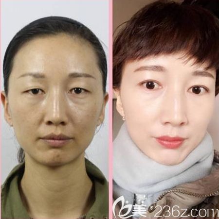 韓國(guó)清潭優(yōu)注射美膚案例 韓國(guó)清潭優(yōu)注射美膚案例