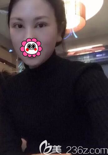 找黎曄主任做完雙眼皮5天拆線恢復(fù)