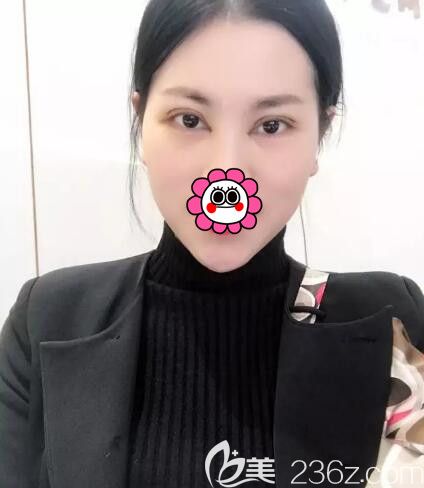 黎曄分享割雙眼皮術(shù)后10天恢復(fù)情況