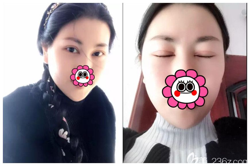 術(shù)后半個(gè)月割雙眼皮恢復(fù)情況閉眼微痕