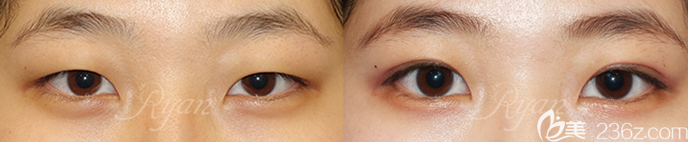韓國瑞恩雙眼皮案例前后效果對比圖