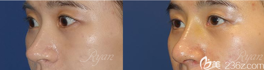 韓國瑞恩隆鼻案例前后效果對比圖