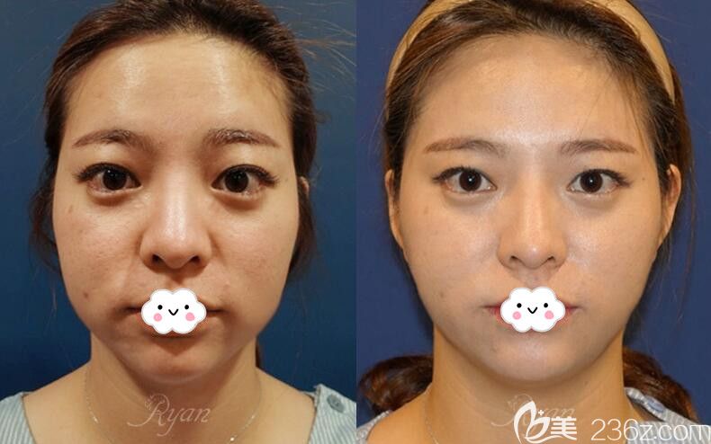 韓國瑞恩超聲超+脂肪溶解針效果前后對比圖