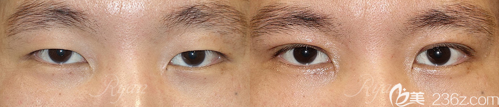 不知男生割雙眼皮自然嗎？韓國(guó)瑞恩崔相文雙眼皮案例
