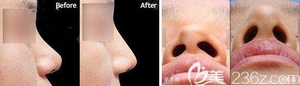 韓國原辰鼻綜合案例 韓國原辰鼻綜合案例