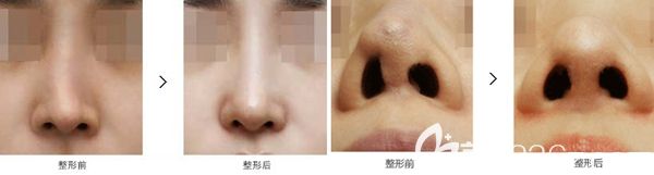 韓國原辰鼻修復手術案例 韓國原辰鼻修復手術案例