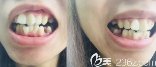 在成都圣貝口腔醫(yī)院戴牙套前的牙齒情況 在成都圣貝口腔醫(yī)院戴牙套前的牙齒情況