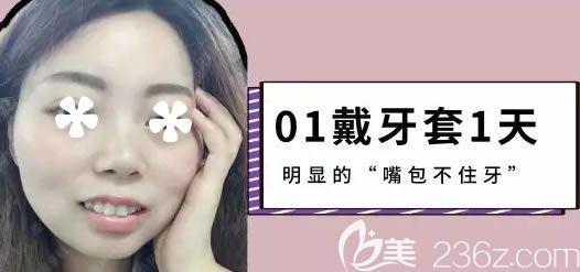 戴半隱形牙套第1天 戴半隱形牙套第1天