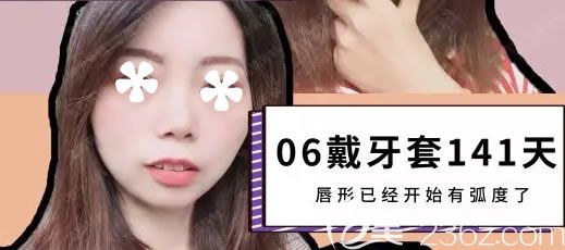 戴牙套141天唇形已經(jīng)開始有弧度了 戴牙套141天唇形已經(jīng)開始有弧度了