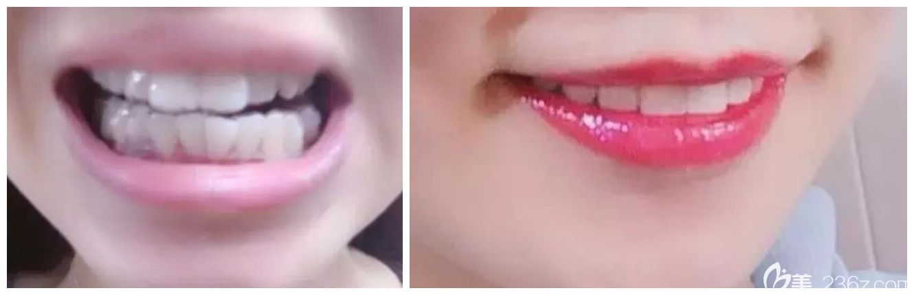 美奧口腔張彼得隱適美隱形矯正擁擠不齊牙齒案例 美奧口腔張彼得隱適美隱形矯正擁擠不齊牙齒案例