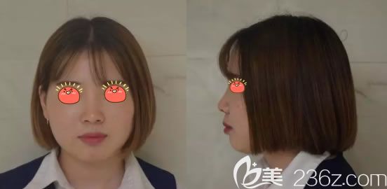 義烏陽光整形做肋軟骨隆鼻前 義烏陽光整形做肋軟骨隆鼻前