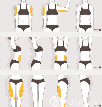 韓國(guó)AP整形外科醫(yī)院吸脂效果原理圖