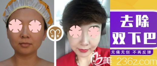 北海美秀中禾整形下巴吸脂前后對比圖 北海美秀中禾整形下巴吸脂前后對比圖