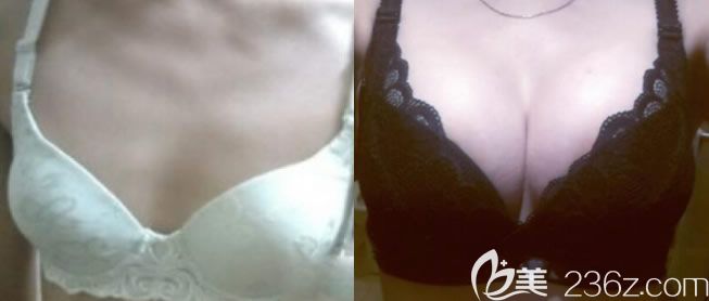 北海美秀中禾隆胸案例效果 北海美秀中禾隆胸案例效果