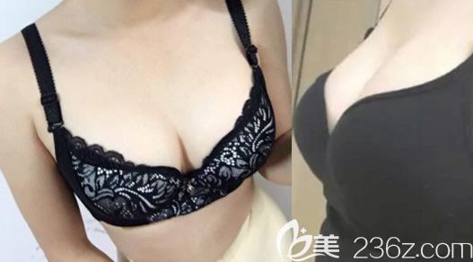 北海整形醫(yī)院哪家好？用我在美秀中禾整形做大腿吸脂和自體脂肪隆胸真實(shí)案例來(lái)說(shuō)話