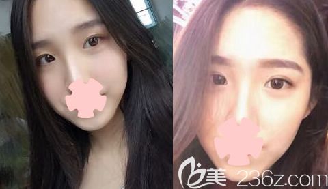 北海美秀中禾整形侯萌萌眼綜合案例 北海美秀中禾整形侯萌萌眼綜合案例