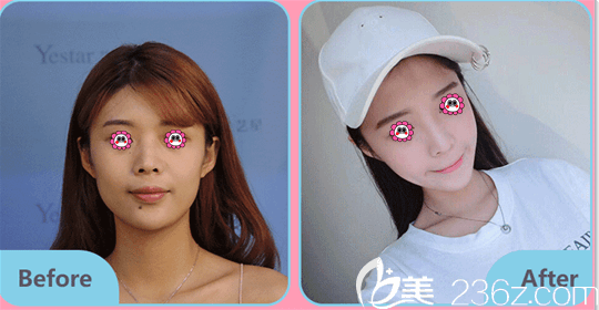 北京藝星胡錦幸醫(yī)生注射瘦臉案例