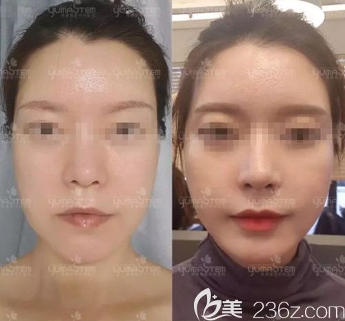 韓國維摩整形外科+線提升案例