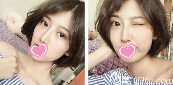 埋線雙眼皮一個月的恢復效果自然有靈氣 埋線雙眼皮一個月的恢復效果自然有靈氣