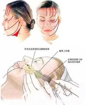 上海伯思立醫(yī)療美容門(mén)診部章春芳 埋線提升