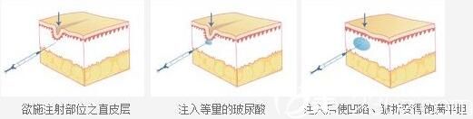 上海伯思立醫(yī)療美容門診部高泉 玻尿酸除皺原理