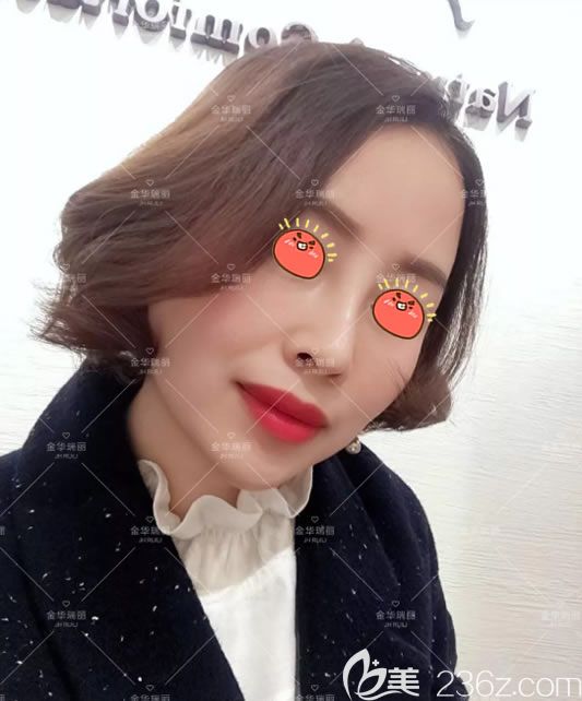 想知道隆鼻術(shù)后多久消腫的姐妹們,可以參考我在金華瑞麗劉政這做完假體隆鼻的恢復(fù)過程