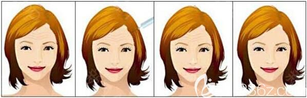 上海伯思立醫(yī)療美容門診部瘦臉除皺除皺<span style=