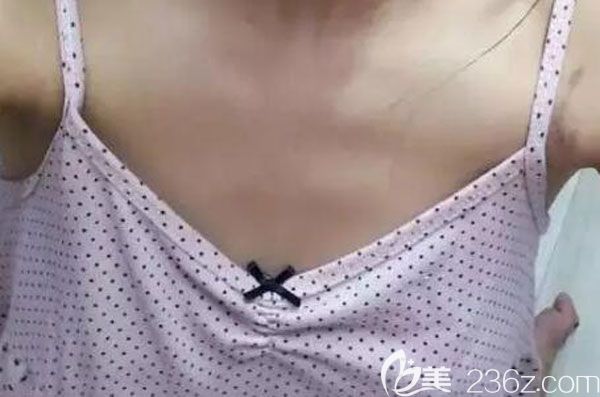 在昆明韓辰整形隆胸手術(shù)前 在昆明韓辰整形隆胸手術(shù)前