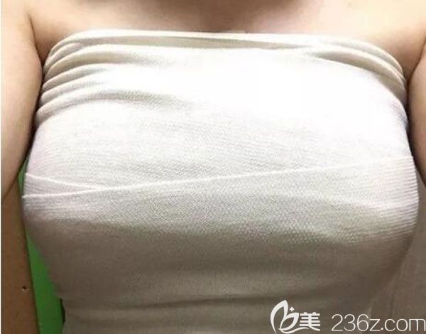 假體隆胸第8天胸部被裹著紗布 假體隆胸第8天胸部被裹著紗布