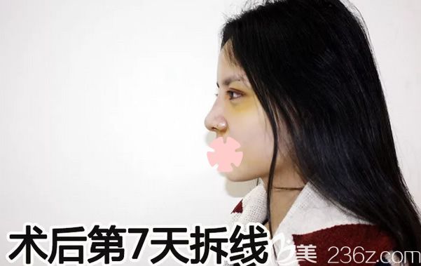 我在柳州華美做鼻綜合和面部自體脂肪填充術(shù)后第7天 我在柳州華美做鼻綜合和面部自體脂肪填充術(shù)后第7天