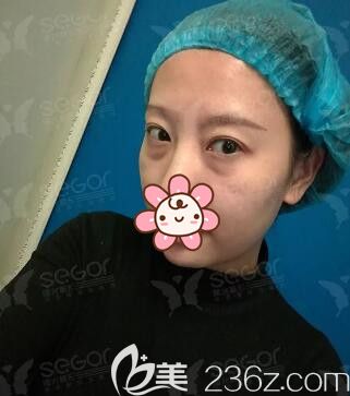 面診常州曙光術(shù)前眼袋較大 面診常州曙光術(shù)前眼袋較大