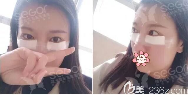 到常州曙光剛做完韓式內(nèi)吸去眼袋 到常州曙光剛做完韓式內(nèi)吸去眼袋