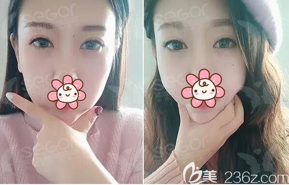 怕縫合拆線恢復(fù)期影響工作，就到常州曙光做了韓式內(nèi)吸祛眼袋告別遺傳+熬夜形成的大眼袋