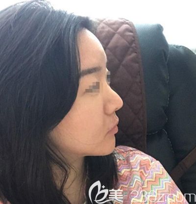 韓國(guó)玉芭做了隆鼻修復(fù)手術(shù)前 韓國(guó)玉芭做了隆鼻修復(fù)手術(shù)前