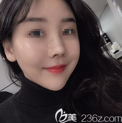 韓國(guó)玉芭做了隆鼻修復(fù)手術(shù)后7天 韓國(guó)玉芭做了隆鼻修復(fù)手術(shù)后7天