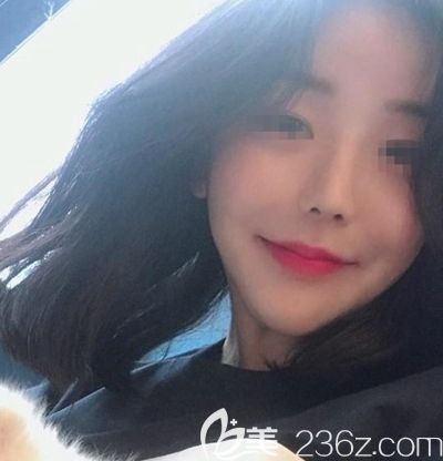 韓國(guó)玉芭做了隆鼻修復(fù)手術(shù)后2周 韓國(guó)玉芭做了隆鼻修復(fù)手術(shù)后2周