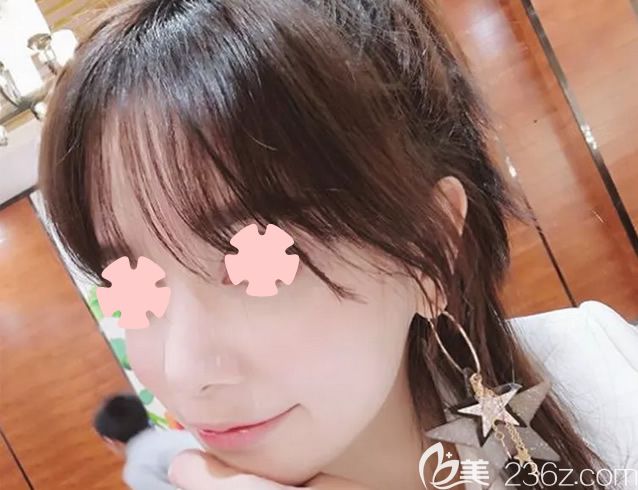 我在柳州華美做隆鼻和面部填充第30天 我在柳州華美做隆鼻和面部填充第30天