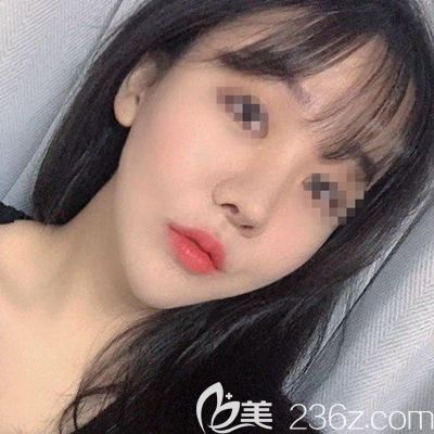 做了隆鼻手術(shù)后透光？我找韓國(guó)玉芭做了隆鼻修復(fù)手術(shù)之后就改善了這個(gè)問(wèn)題