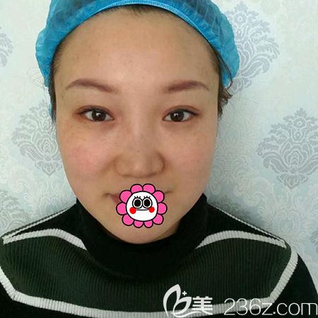 佳木斯韓藝來(lái)鼻綜合手術(shù)前 佳木斯韓藝來(lái)鼻綜合手術(shù)前