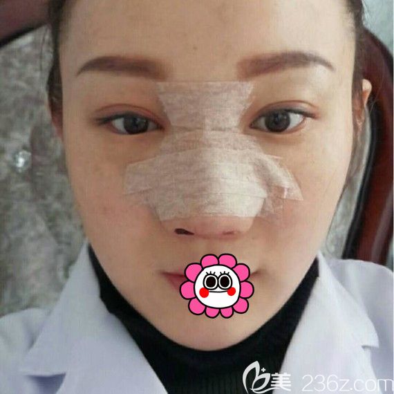 佳木斯韓藝來(lái)找李明賢做的鼻綜合3天 佳木斯韓藝來(lái)找李明賢做的鼻綜合3天