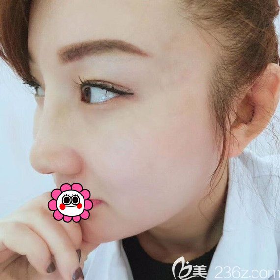 佳木斯韓藝來(lái)耳軟骨隆鼻術(shù)后7天 佳木斯韓藝來(lái)耳軟骨隆鼻術(shù)后7天