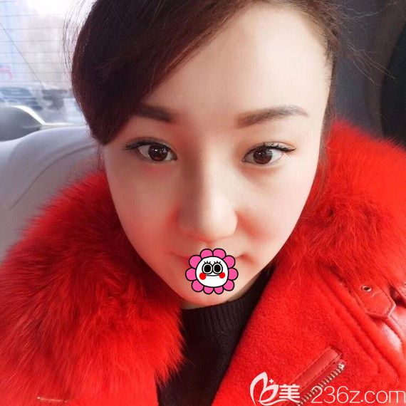 李明賢耳軟骨隆鼻恢復(fù)1個(gè)月 李明賢耳軟骨隆鼻恢復(fù)1個(gè)月