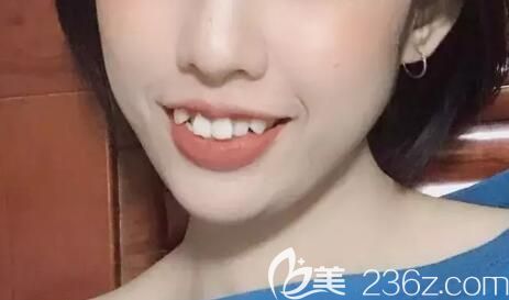 去杭州美奧口腔矯正前照片 去杭州美奧口腔矯正前照片