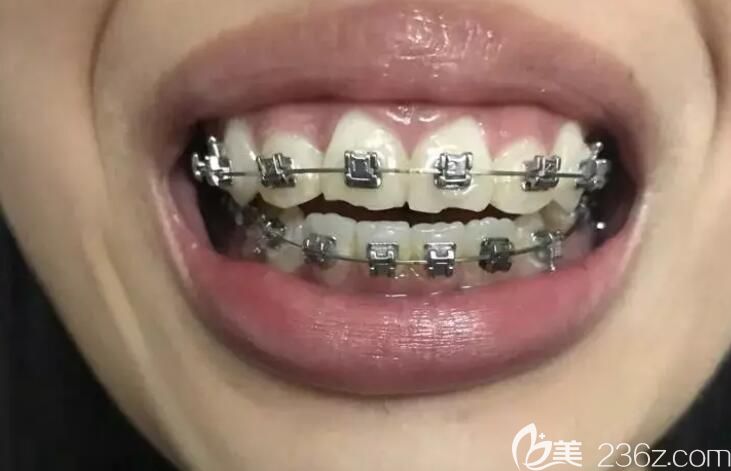 杭州美奧口腔牙齒矯正100天效果圖 杭州美奧口腔牙齒矯正100天效果圖