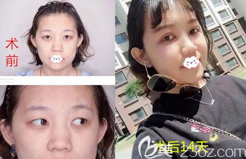 韓國愛慕雙眼皮前后效果對(duì)比圖