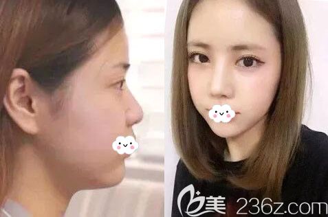 韓國愛慕整形外科醫(yī)院韓式隆鼻案例