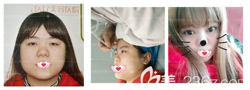 孫蘇寧醫(yī)生做雙眼皮案例 孫蘇寧醫(yī)生做雙眼皮案例