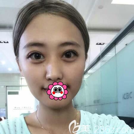 佳木斯韓藝來李明賢切開雙眼皮10天