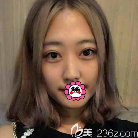 心動(dòng)不如行動(dòng)，來佳木斯韓藝來找李明賢做切開雙眼皮的效果令我很滿意